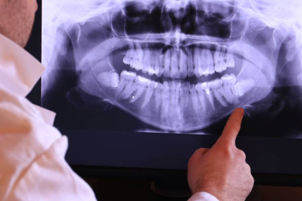 Best Emergency Dentist for Lost Fillings or Crowns in Atlantic City, NJ